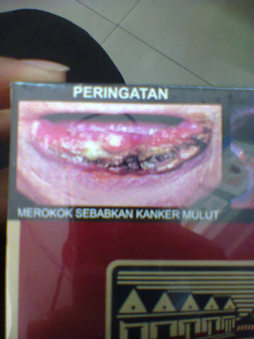 merokok dapat menyebabkan kanker mulut