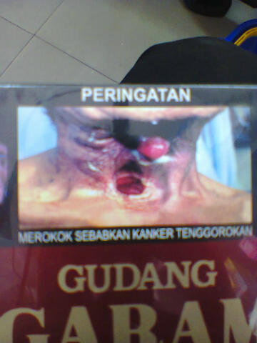 merokok sebabkan kanker tenggorokan